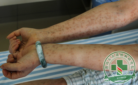 正確有效護(hù)理女性銀屑病的方法大搜集 快來了解有哪些