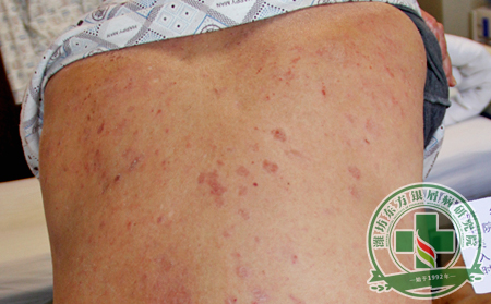 預防銀屑病夏季復發需做到哪些預防護理工作?