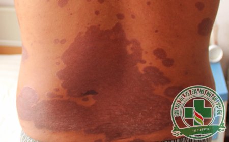 銀屑病怎么治療