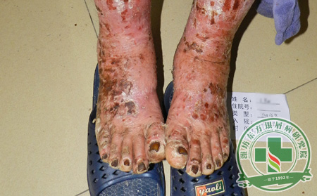 眼部遭受哪些的病變危害是因關節型銀屑病而產生的?