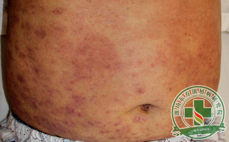 如何衡量一種銀屑病的治療方法是不是可靠?