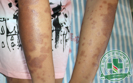 暑期學生銀屑病患者該如何護理?