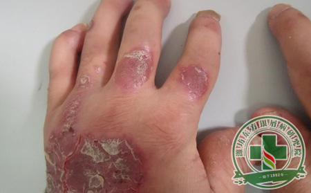 關(guān)節(jié)型銀屑病患者怎樣才能讓關(guān)節(jié)炎遠(yuǎn)離