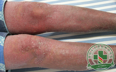 哪些誤區拖了銀屑病患者臨床治療的后腿?