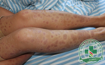 預防復發(fā)是銀屑病患者需要修煉的重要課題