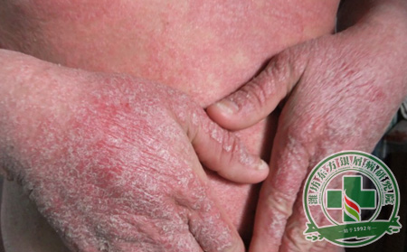 蒸籠天紅皮型銀屑病患者生活中要注意什么