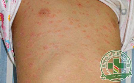 早察覺早看?。褐委熴y屑病就要趁早