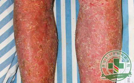 如何幫助紅皮型銀屑病患者提神抗病護(hù)理健康?