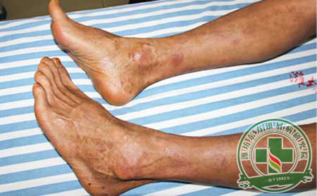 女性治療銀屑病別心急 這些問題先弄清