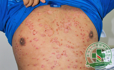 如何預(yù)防尋常型銀屑病向其他病型轉(zhuǎn)變?