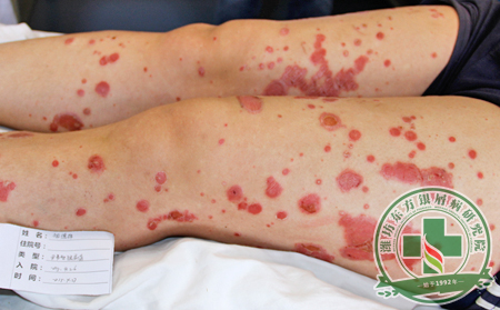 怎么治療銀屑病較為有效