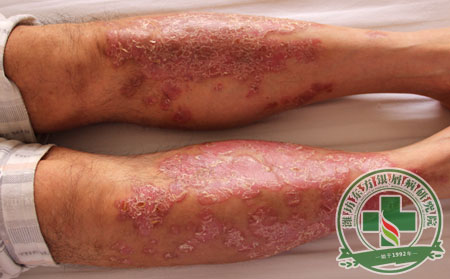 銀屑病治療,濰坊醫生,銀屑病患者