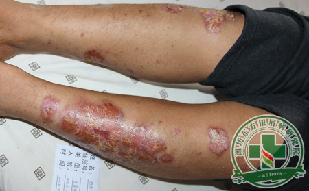 加長版三伏天銀屑病患者該如何應對