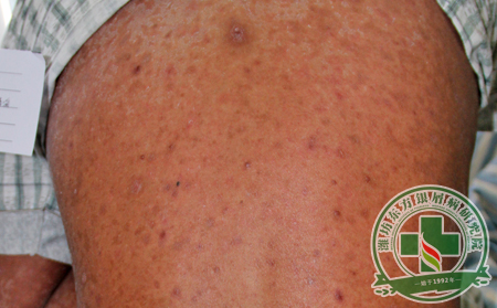 為什么選擇濰坊銀屑病醫院治療銀屑病