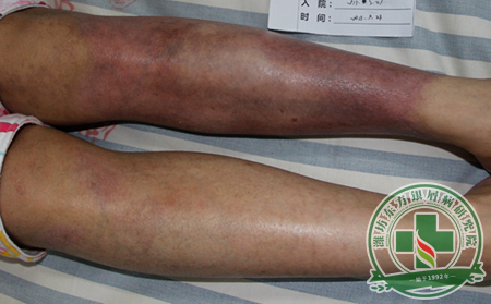 濰坊銀屑病患者想知道尋常型銀屑病的癥狀特征