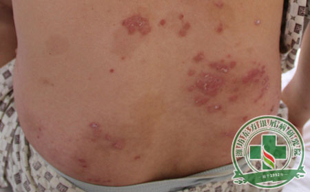 濰坊銀屑病尋常型癥狀有哪些