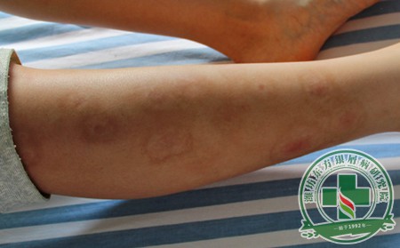 濰坊銀屑病怎么治療非常好啊