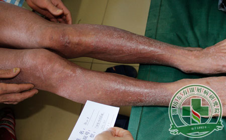 這些小細節(jié)是銀屑病護理方法提倡的重要環(huán)節(jié)