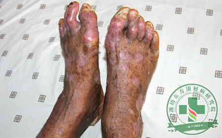 這樣護理關節型銀屑病病情能見可以