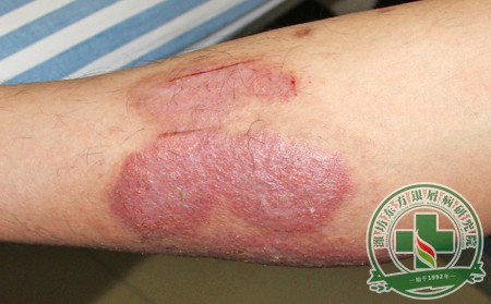 發(fā)展期銀屑病的護(hù)理要點(diǎn)分析