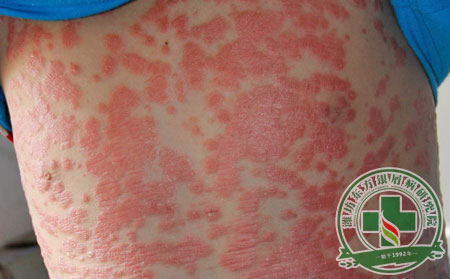 預防秋季銀屑病加重復發 患者應從哪些方面入手