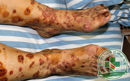 秋季加深關節型銀屑病患者如何護理關節