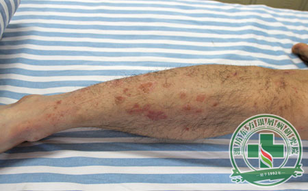 拖延牛皮癬治療可能給患者帶來的嚴重危害后果