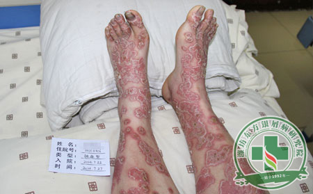 有效的銀屑病治療方法應包含如下治療關鍵點