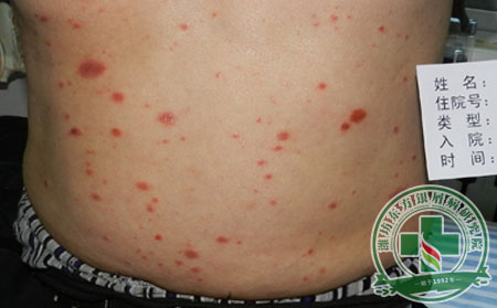 尋常型銀屑病臨床癥狀程度大比拼