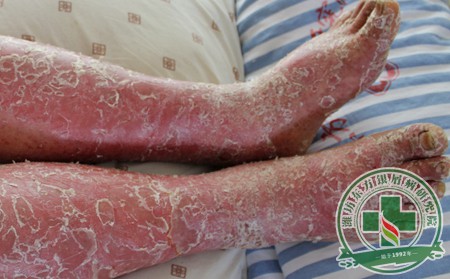 秋季鱗屑出沒(méi) 銀屑病患者科學(xué)抑制防復(fù)發(fā)