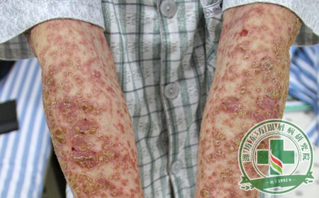 重癥銀屑病的危害提醒患者銀屑病治療需科學(xué)