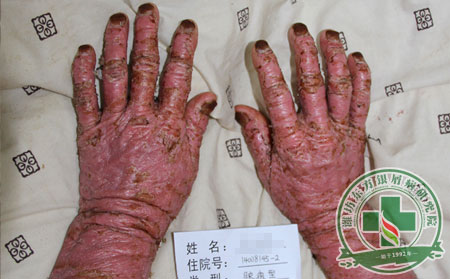 根據關節型銀屑病癥狀圖片詳解患病癥狀