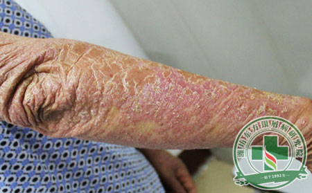 關節痛癢難忍 銀屑病關節炎患者如何過度