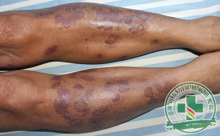 全面治療 銀屑病治療過程中不可忽視的心理因素