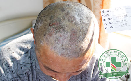 頭部銀屑病難控制 患者需要怎樣的治療來(lái)應(yīng)對(duì)