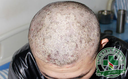 秋風吹起面部鱗屑 銀屑病患者如何進行面部護理?