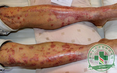 條條梳理銀屑病治療時患者要謹慎對待的問題