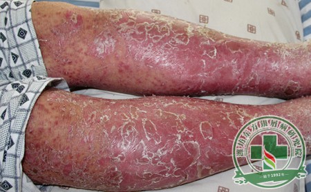 淺析不同方法治療 銀屑病患者效果的差異