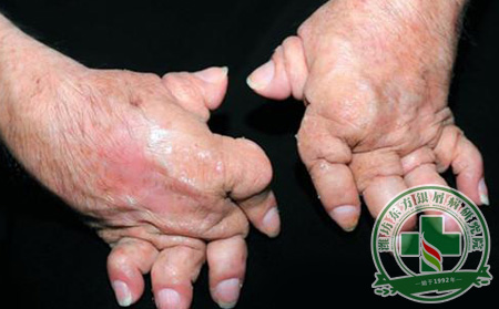 山東治療銀屑病好的醫院在哪里