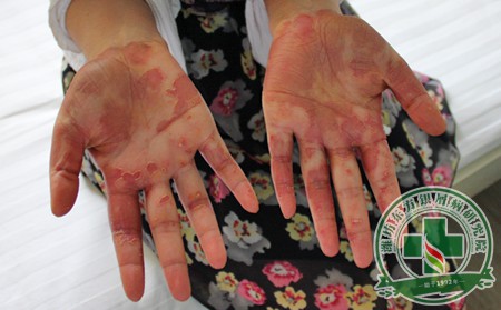 手部尋常型銀屑病癥狀