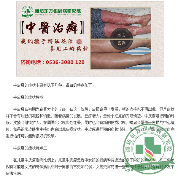 東方多角度詳解牛皮癬癥狀表現