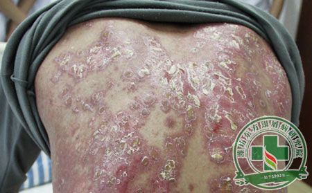 解惑：以毒攻毒治療銀屑病的理論靠譜嗎