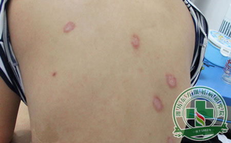 銀屑病治療：治療護理兩手抓 銀屑病別想再猖狂