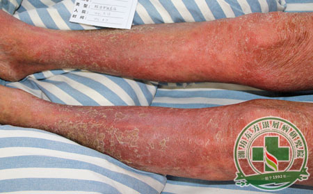 尋常型銀屑病為何尋常 其癥狀又是怎樣表現