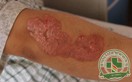 膿皰型銀屑病不是兒戲 是什么誘發(fā)了該病？