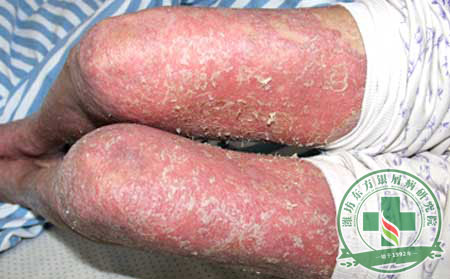 皮膚潮紅 濰坊東方為我們講述紅皮型銀屑病的由來