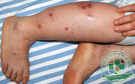 山東到底哪家醫院看銀屑病牛皮癬效果好?