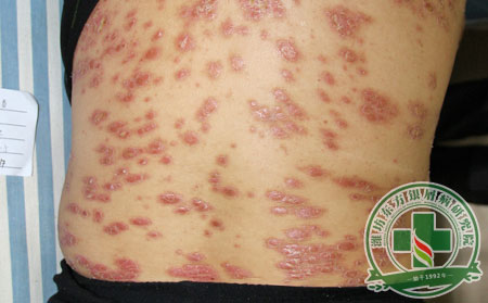 有效治療銀屑病 患者要牢記這三點