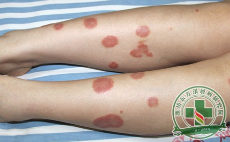 濰坊地區(qū)銀屑病怎么治療好得快