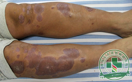 山東濟(jì)寧患者提問：頑固銀屑病的治療方法有哪些